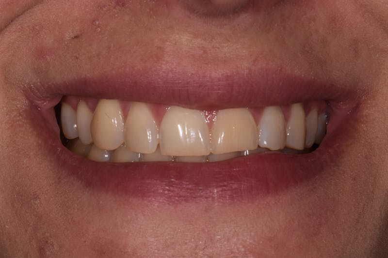 Patient Smile Before & After Gallery - Patient 176655 - Image 3