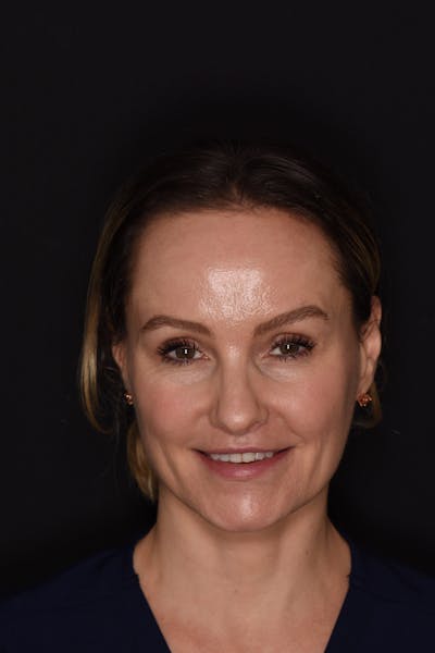 Patient Smile Before & After Gallery - Patient 740047 - Image 1