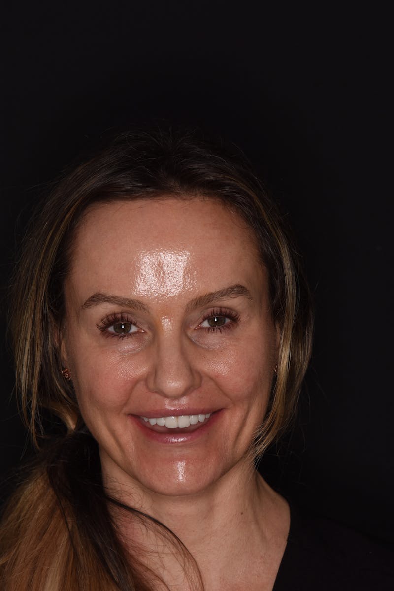 Patient Smile Before & After Gallery - Patient 740047 - Image 2