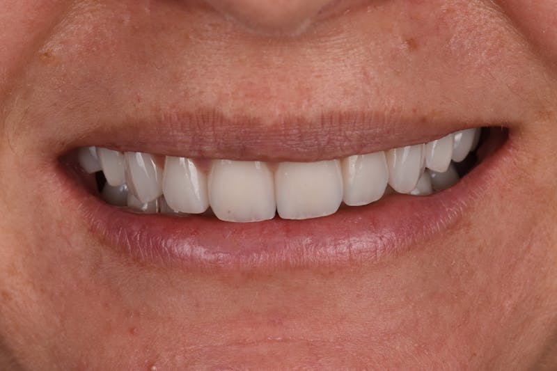 Patient Smile Before & After Gallery - Patient 740047 - Image 4