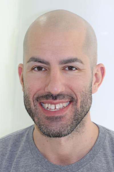 Patient Smile Before & After Gallery - Patient 174447 - Image 1