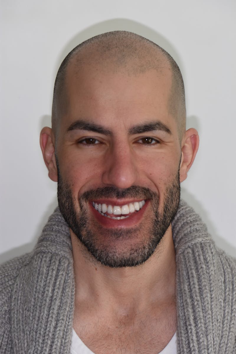 Patient Smile Before & After Gallery - Patient 174447 - Image 2