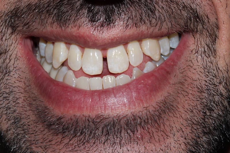 Patient Smile Before & After Gallery - Patient 174447 - Image 3