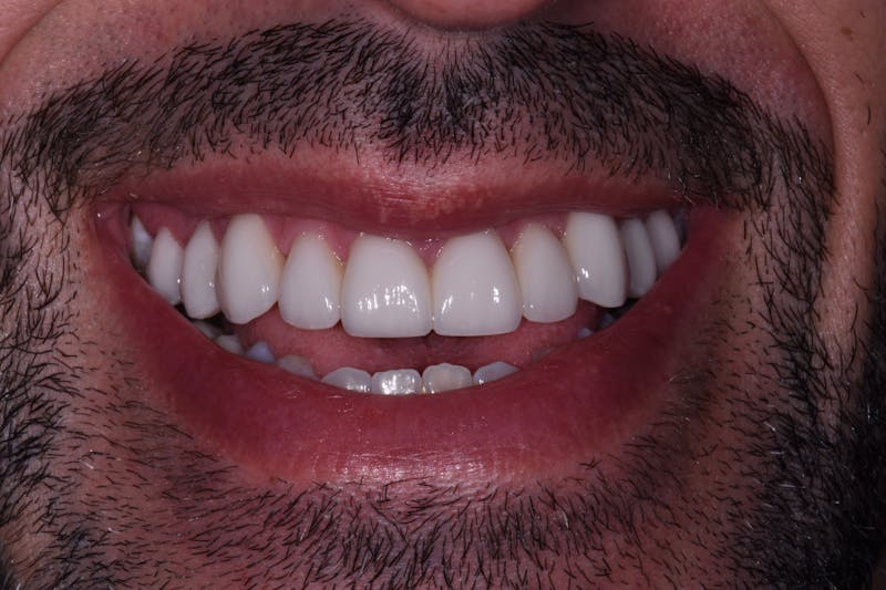 Patient Smile Before & After Gallery - Patient 174447 - Image 4