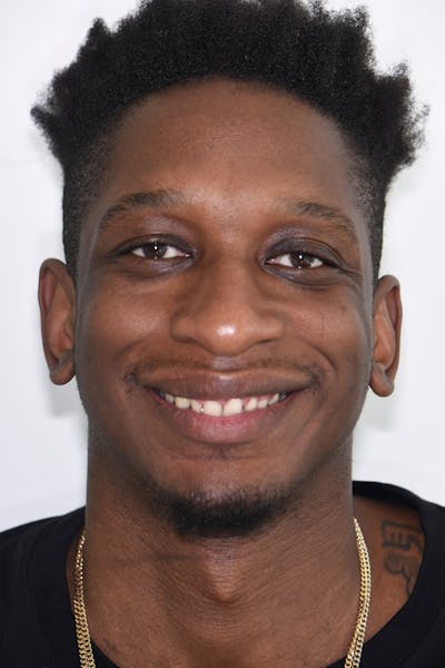 Patient Smile Before & After Gallery - Patient 161159 - Image 1