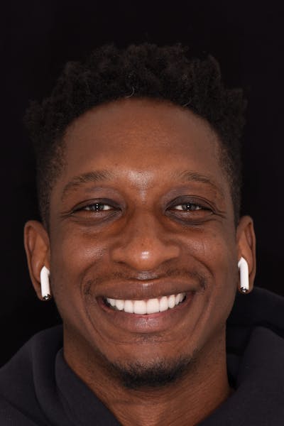 Patient Smile Before & After Gallery - Patient 161159 - Image 2