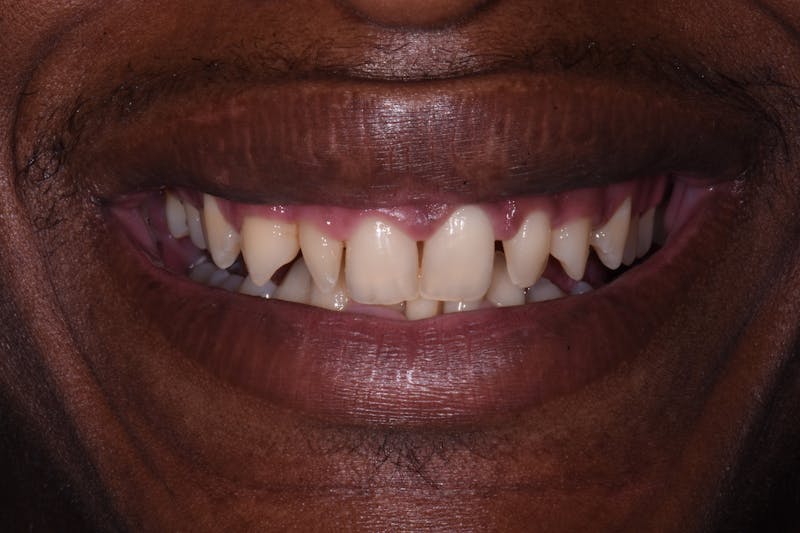Patient Smile Before & After Gallery - Patient 161159 - Image 3