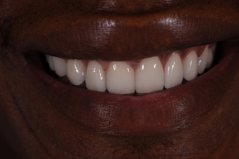 Patient Smile Before & After Gallery - Patient 161159 - Image 4