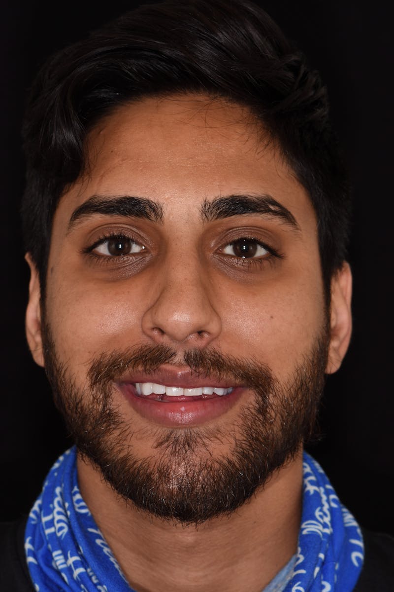 Patient Smile Before & After Gallery - Patient 355351 - Image 1