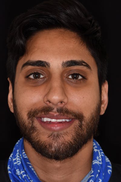 Patient Smile Before & After Gallery - Patient 355351 - Image 1