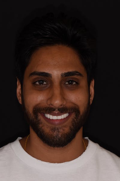 Patient Smile Before & After Gallery - Patient 355351 - Image 2