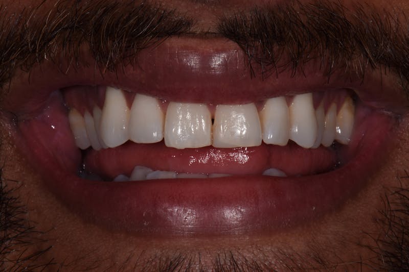 Patient Smile Before & After Gallery - Patient 355351 - Image 3