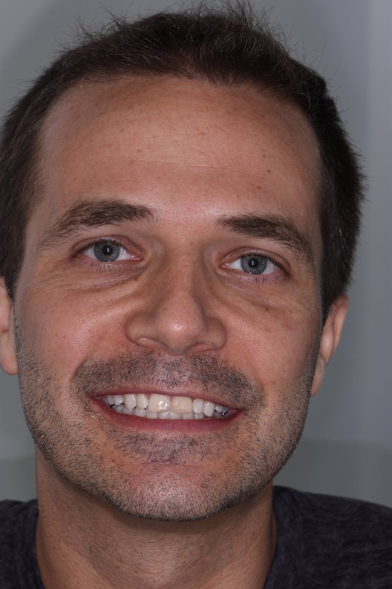 Patient Smile Before & After Gallery - Patient 414163 - Image 1