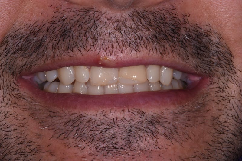Patient Smile Before & After Gallery - Patient 414163 - Image 3