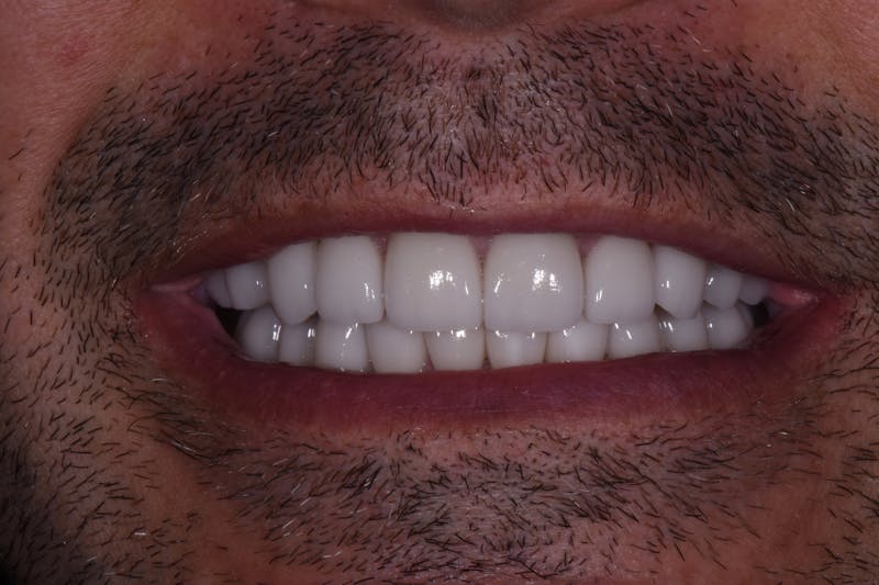 Patient Smile Before & After Gallery - Patient 414163 - Image 4