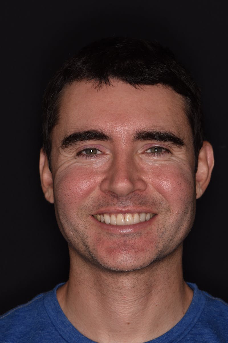 Patient Smile Before & After Gallery - Patient 320626 - Image 1