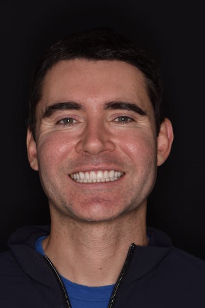 Patient Smile Before & After Gallery - Patient 320626 - Image 2