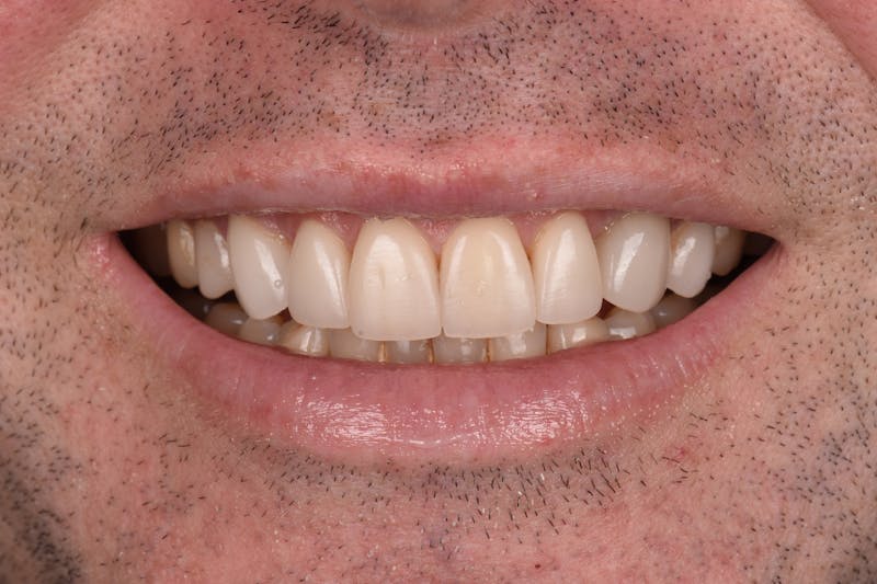 Patient Smile Before & After Gallery - Patient 320626 - Image 3