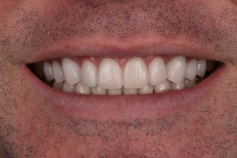 Patient Smile Before & After Gallery - Patient 320626 - Image 4