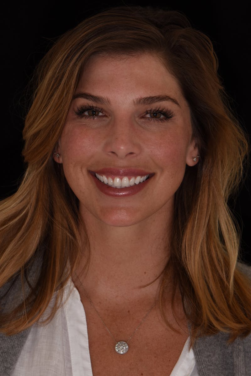 Patient Smile Before & After Gallery - Patient 117262 - Image 1