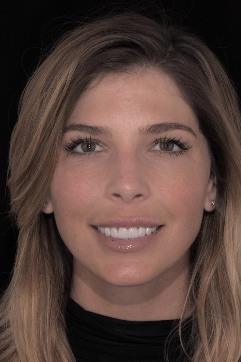 Patient Smile Before & After Gallery - Patient 117262 - Image 2