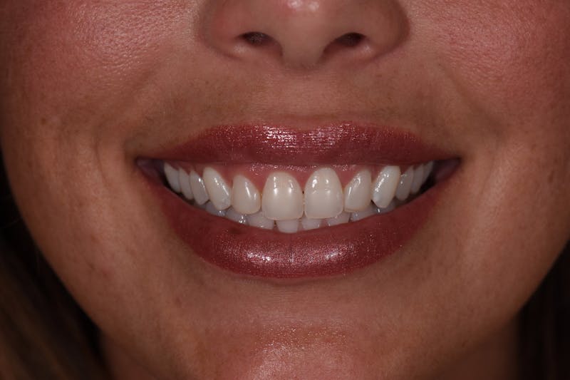 Patient Smile Before & After Gallery - Patient 117262 - Image 3
