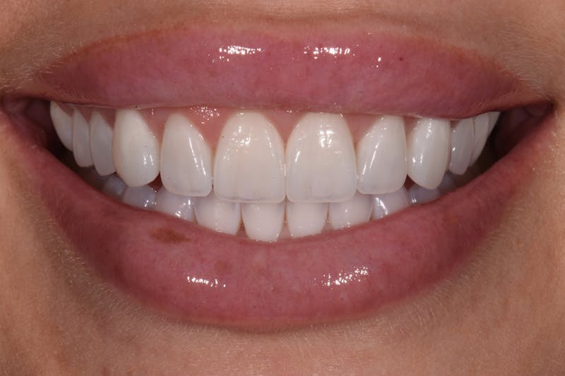 Patient Smile Before & After Gallery - Patient 117262 - Image 4