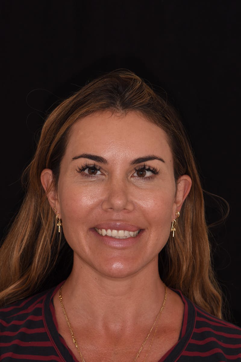 Patient Smile Before & After Gallery - Patient 225218 - Image 1