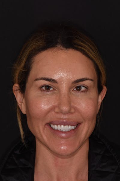 Patient Smile Before & After Gallery - Patient 225218 - Image 2