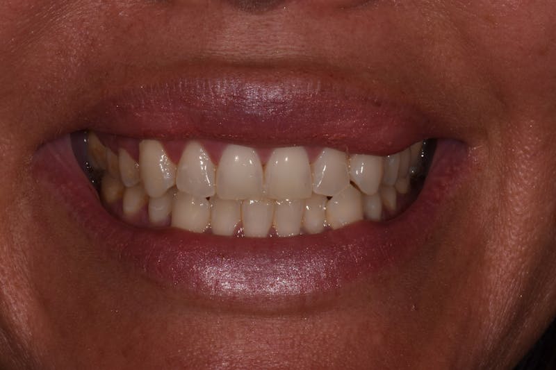 Patient Smile Before & After Gallery - Patient 225218 - Image 3