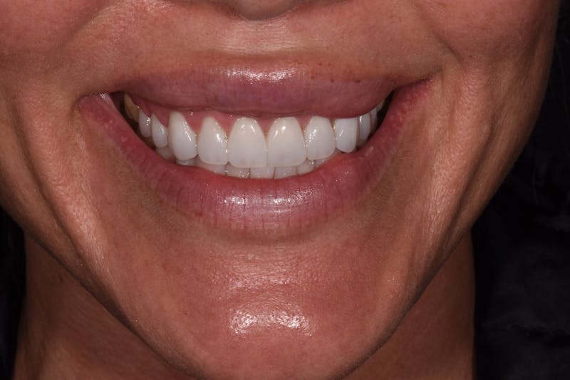 Patient Smile Before & After Gallery - Patient 225218 - Image 4
