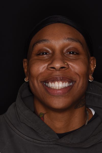 Patient Smile Before & After Gallery - Patient 261653 - Image 2