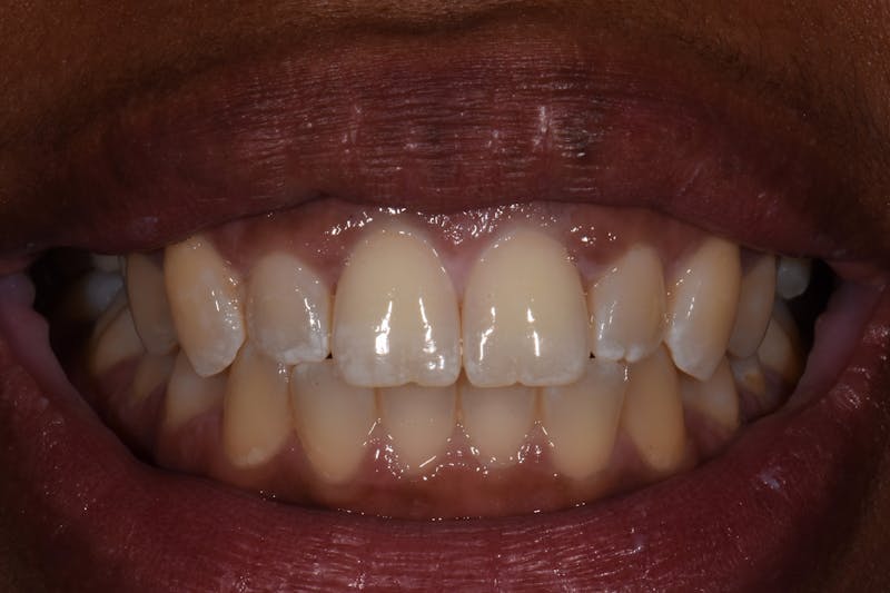 Patient Smile Before & After Gallery - Patient 261653 - Image 3