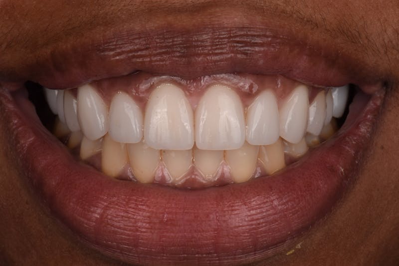 Patient Smile Before & After Gallery - Patient 261653 - Image 4