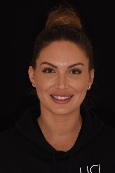 Patient Smile Before & After Gallery - Patient 225158 - Image 1