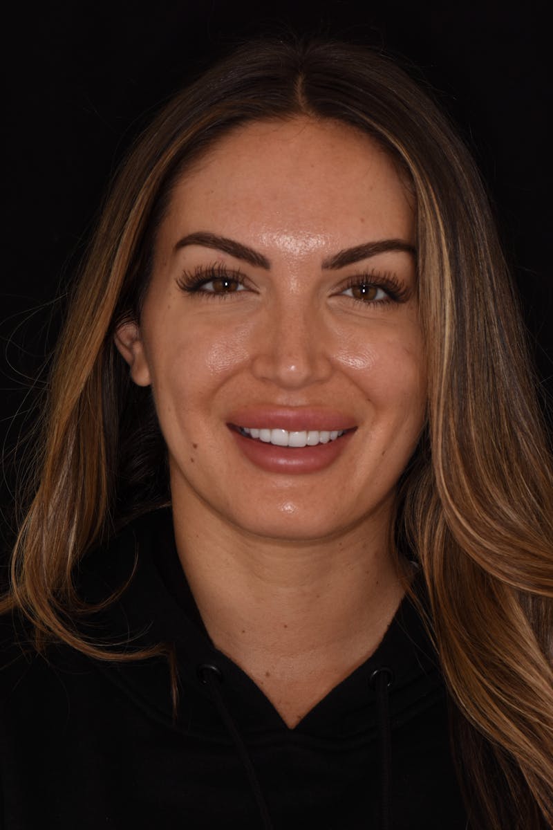 Patient Smile Before & After Gallery - Patient 225158 - Image 2