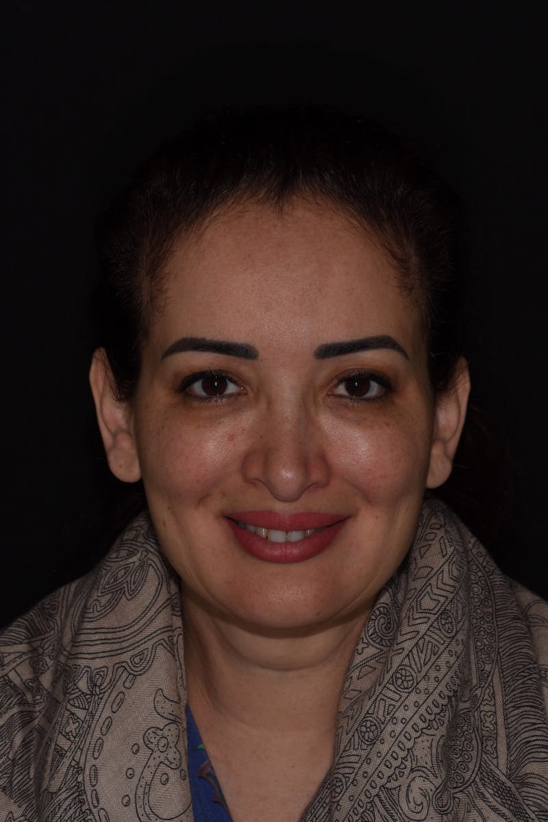 Patient Smile Before & After Gallery - Patient 304736 - Image 1