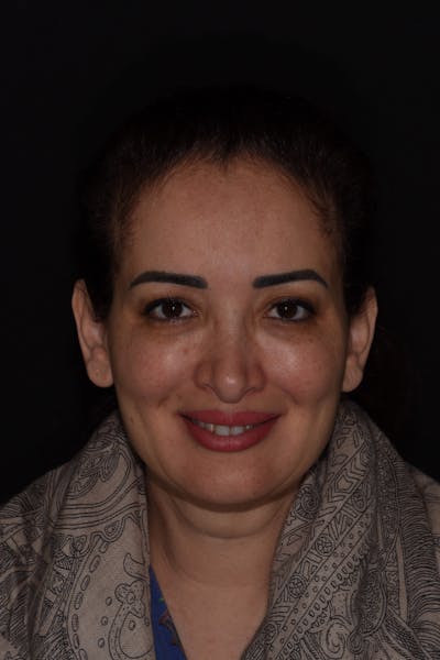 Patient Smile Before & After Gallery - Patient 304736 - Image 1