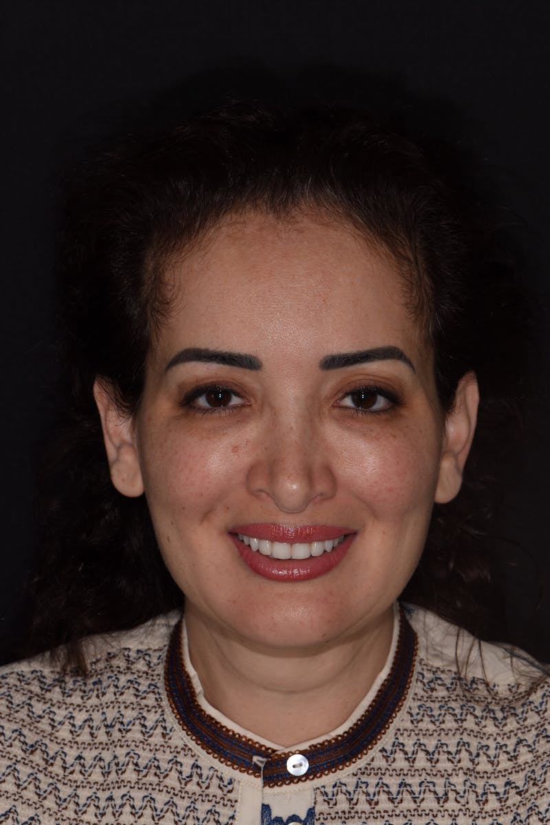 Patient Smile Before & After Gallery - Patient 304736 - Image 2