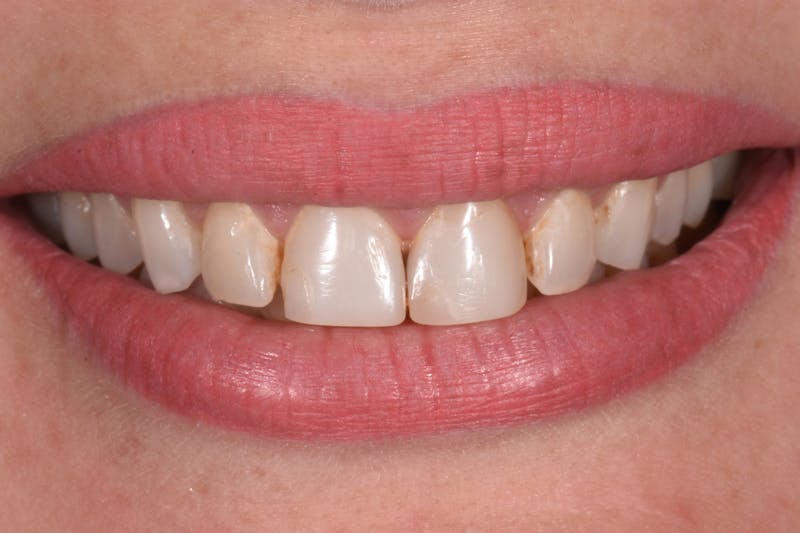 Patient Smile Before & After Gallery - Patient 304736 - Image 3