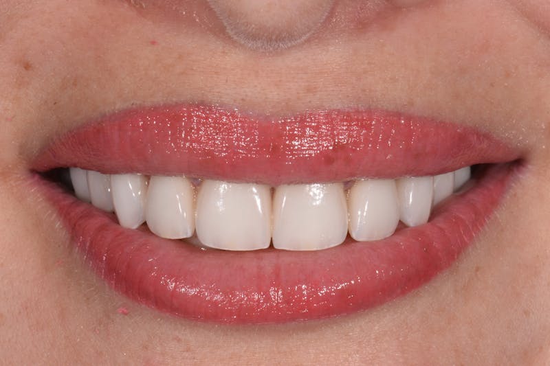 Patient Smile Before & After Gallery - Patient 304736 - Image 4