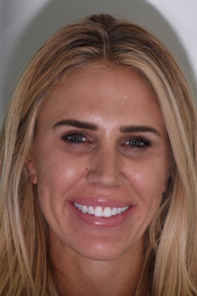 Patient Smile Before & After Gallery - Patient 376187 - Image 1