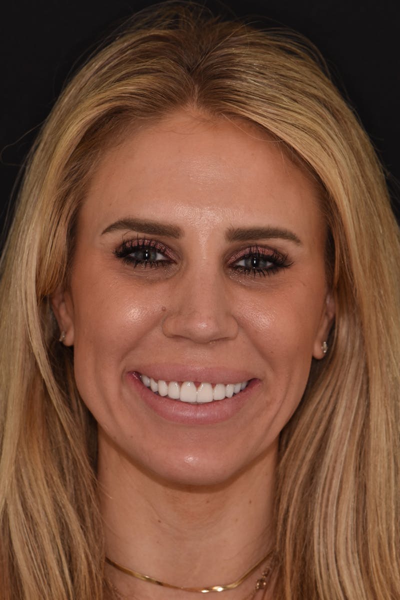 Patient Smile Before & After Gallery - Patient 376187 - Image 2