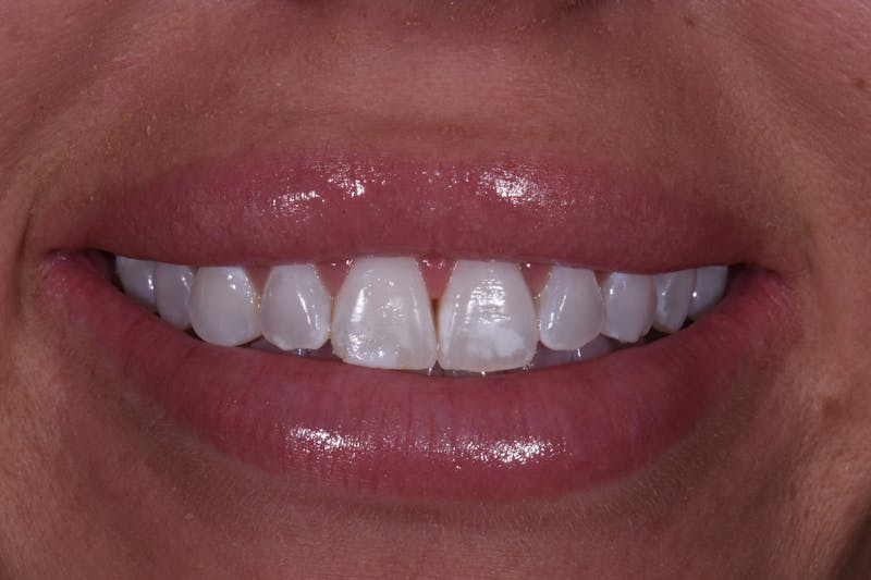 Patient Smile Before & After Gallery - Patient 376187 - Image 3