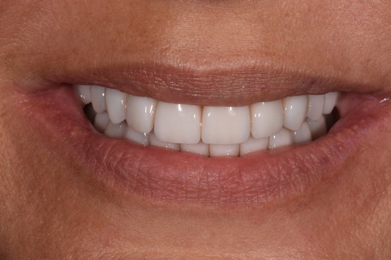 Patient Smile Before & After Gallery - Patient 150326 - Image 2