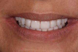 Patient Smile Before & After Gallery - Patient 150326 - Image 2