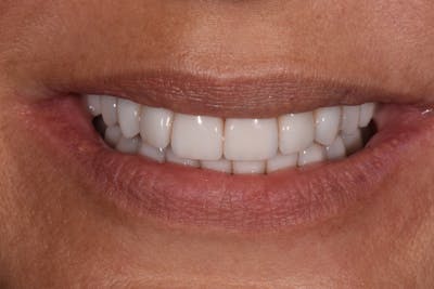 Patient Smile Before & After Gallery - Patient 150326 - Image 2