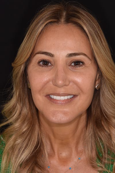 Patient Smile Before & After Gallery - Patient 182556 - Image 1