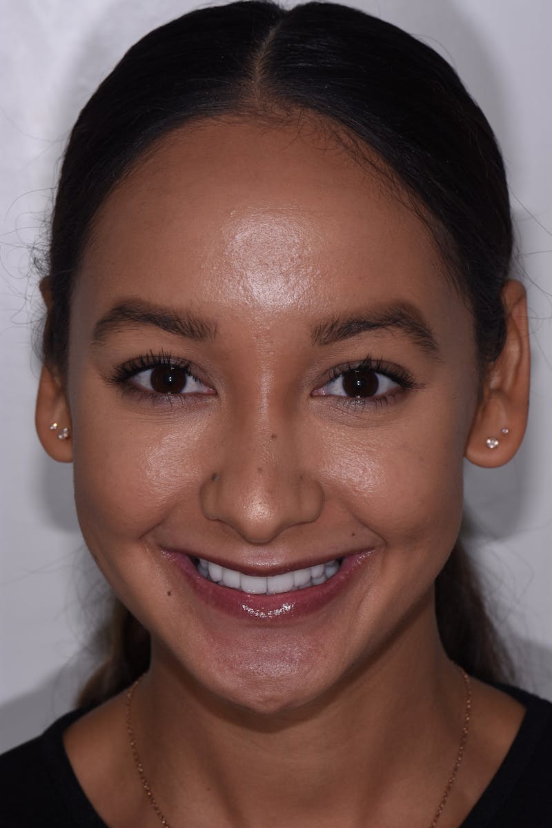 Patient Smile Before & After Gallery - Patient 171178 - Image 2