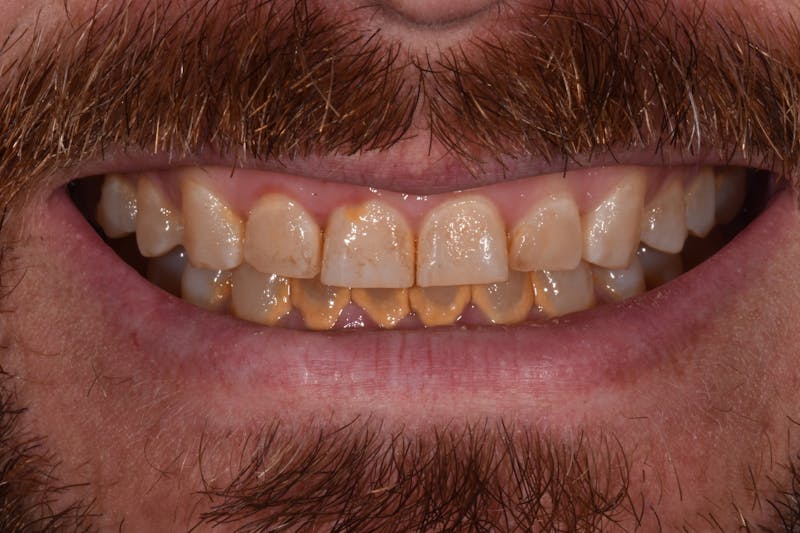 Patient Smile Before & After Gallery - Patient 495410 - Image 3